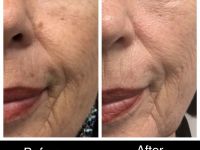 Skin Rejuvenation